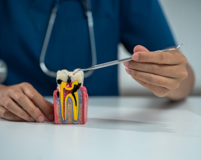 Root Canal Treatment